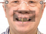 Fig 9. By merging the Duchenne smile photograph, intraoral scan, and CBCT scan of the maxilla, the planning of implant placement in the maxilla was started in a facially driven approach.