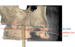 Fig 11. By merging the Duchenne smile photograph, intraoral scan, and CBCT scan of the maxilla, the planning of implant placement in the maxilla was started in a facially driven approach.