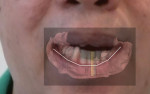 Fig 12. By merging the photograph showing the patient speaking, intraoral scan, and CBCT scan of the mandible, the planning of implant placement in the mandible was started.
