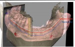 Fig 13. By merging the photograph showing the patient speaking, intraoral scan, and CBCT scan of the mandible, the planning of implant placement in the mandible was started.