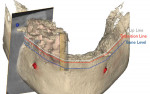 Fig 14. By merging the photograph showing the patient speaking, intraoral scan, and CBCT scan of the mandible, the planning of implant placement in the mandible was started.