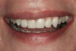 Figure 8  Full-smile view of the custom-characterized, same-day e.max crown on tooth No. 7, cemented provisionally.