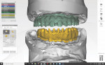 Fig 22. The digital designs of the framework and crowns.