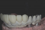 Fig 26. The lithium disilicate anterior crowns are bonded to the PEKK framework.