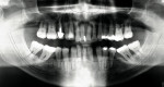 Figure 2  The patient presented with severe generalized periodontal disease and bone loss of existing teeth.