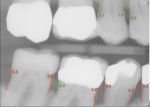 Powerful AI outputs highlighting areas of potential periodontal concern (bone levels in red in excess of 3 mm from CEJ to Crest of Bone and those in green less than 3 mm). Root surface calculus detected and highlighted within orange detection boxes. Coupling this information with periodontal probing depths will help inform the hygienist and patient of areas requiring potential attention. (Image courtesy of Overjet, Inc.)