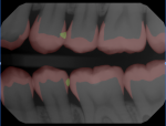AI algorithms trained to identify dental caries (yellow outlines on the distal surface of Nos. 12 and 20) as well as enamel (red masking) and provide clinical insight of which lesions to potentially watch or recommend treatment of based on evidence based science. (Image courtesy of Overjet, AI)