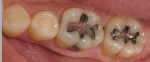Figure 1  Preoperative view of defective amalgam restorations.