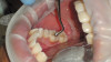 Figure 5  The zenith of the maxillary central incisor should be distal to the middle of the tooth.