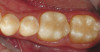 Figure 7b  This case is an example of the importance of evaluating the bite with the joints seated in a stable position. Orthodontic treatment was rendered to correct a "deep overbite" and trauma to the maxillary incisors. B) Handheld models showing correction of the deep overbite after orthodontics has been completed. The patient complained of "jaw" discomfort after orthodontic treatment.