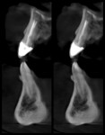 Preoperative 3D CBCT view showing horizontal fracture of tooth No. 9.