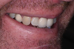 Preoperative right lateral smile photograph.
