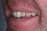 Preoperative left lateral smile photograph.