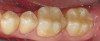 Figure 7c  This case is an example of the importance of evaluating the bite with the joints seated in a stable position. Orthodontic treatment was rendered to correct a "deep overbite" and trauma to the maxillary incisors. C) Models mounted in CR after use of a superior repositioning splint to stabilize the joints. With stabilized joints, the true malocclusion is uncovered. The patient went back into orthodontic treatment and required mandibular advancement surgery.