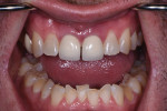 Preoperative retracted view with teeth apart. Note the extensive wear and crowding of the mandibular anterior teeth.