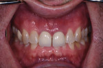 Preoperative retracted view with teeth closed. Note the deep bite and the overall gingival redness in the area of treatment.