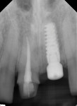 Postoperative periapical radiograph following extraction of tooth No. 9 and implant placement.