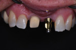 Retracted maxillary view with contraster in place to help communicate tooth characteristics to the laboratory.