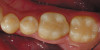 Figure 7d  Intraoral view of the occlusion of patient from Figure 7 after retreatment. The occlusion is adequate to finish with equilibration. D) Models mounted in CR after retreatment.