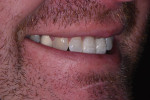 Right lateral smile view of the final restorations.