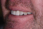 Left lateral smile view of the final restorations.