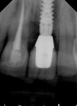 Posttreatment periapical radiograph of the final restorations.