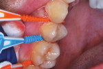 SDF-soaked soft dental picks inserted after flossing and drying of interproximal sites.