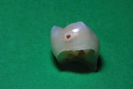 Caries lesion visible on primary second molar immediately after exfoliation.