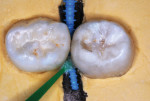 SDF applied to an experimental model in which the exfoliated primary second molar was placed in contact with an extracted third molar in hardened dental stone. The leather shoelace simulates soft-tissue papilla.