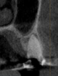 Comparison of CBCT images taken prior to and 4 months after socket grafting, respectively. Note how the alveolar ridge was adequately maintained.