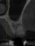 Comparison of CBCT images taken prior to and 4 months after socket grafting, respectively. Note how the alveolar ridge was adequately maintained.