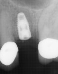 Immediate postoperative radiograph following placement of a 4.3 x 8 mm tapered implant.