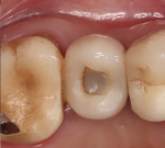 Postoperative 30-month occlusal view of the final restoration.