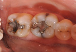 Figure 1  Patient presented with two failing amalgams on lower right; fracture lines extended from tooth No. 30 and there was recurrent decay around tooth No. 31.