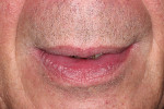 Fig 6. Close-up view of lips in repose; note tooth position relative to the lip is unable to be determined.