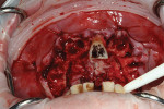 Fig 11. Post extraction of the maxillary teeth, with one tooth retained to facilitate guide placement and alignment.