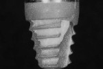 Fig 2. RBM implant surface treated with Er:YAG laser was graded as minimally effective at removing the resin cement. Cement was removed from the crest of the implant threads but not within the concavities between the threads. Minimal scratching of the implant surface was evident. The Er,Cr:YSGG and Nd:YAG lasers showed similar results when used as monotherapies.