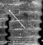 Fig 5. SEM of implant in Fig 4 revealed significant residual cement between all threads. Ti curet appeared to have flattened and smeared the crests of the implant threads (inset). Similar findings were observed with magnetostrictive and piezo ultrasonic scalers. Original magnification of 20x, Bar = 1 mm. Inset, original magnification of 100x, Bar = 200 μm.