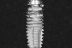 Fig 8. Cement graded as having been moderately removed from DAE surface by Nd:YAG + piezo scaler protocol. Scratching and flattening of the crest of the implant threads is visible.