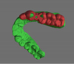 Fig 3. Maxillary STL file used to design surgical guide in planning software.