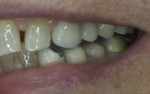 Fig 8. Clinical photograph of No. 12 screw-retained zirconia crown.