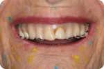Fig 3. Teeth are unesthetically displaced in the smile.