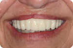Fig 8. Monochromatic try-ins can be difficult to evaluate as a natural smile preview, and often can disappoint when the only full-color visualization is after the prosthesis is complete.