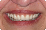Fig 9. Monochromatic try-ins can be difficult to evaluate as a natural smile preview, and often can disappoint when the only full-color visualization is after the prosthesis is complete.