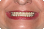 Fig 15. The existing denture as represented in the patient’s smile.