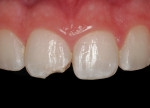 Figure 1  Fracture of the right maxillary central incisor.