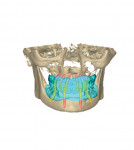Fig 20. The compiled implant planning data created by combining CBCT scans of the 3D printed wax try-ins during the clinical records appointment.