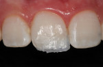 Figure 4  Dentin shade of composite and dentinal mamelon detail.