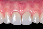Fig 15. Clinical appearance of the achieved pink and white esthetics at follow-up at 32 months.