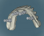 Figure 4  The zirconia substructure was designed using advanced CAD/CAM software.